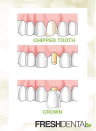 Dental Crowns in Concord NC