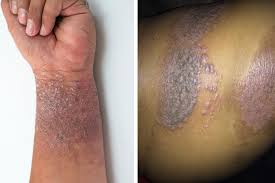 Image result for psoriasis