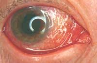 Image result for Gonococcal Conjunctivitis