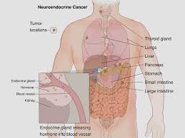 However, these symptoms may not appear for many years as stomach cancers grow very slowly. Neuroendocrine Cancer Care And Treatment Osuccc James