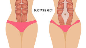 It commonly occurs during pregnancy to make room for your growing baby. Diastasis Recti And Core Strength During Pregnancy Juna