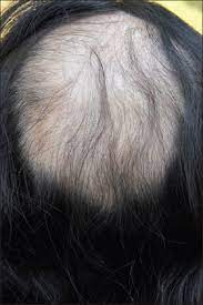 However, for about 60%, hair loss persists for 6 or more months after completion of radiotherapy, the authors note. Radiation Induced Temporary Alopecia After Embolization Of Cerebral Aneurysm Verma S Srinivas C R Thomas M Indian J Dermatol