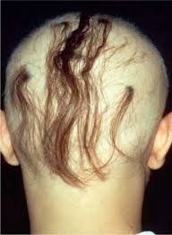 You can drink alcohol while taking amoxicillin. Alopecia Areata An Overview Sciencedirect Topics