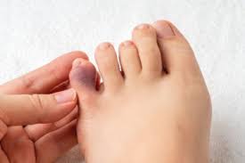 Image result for Toe Fracture