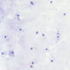 Falciparum life cycle, symptoms, diagnosis, treatment and plasmodium falciparum is the plasmodium species responsible for 85 % of the malaria cases. Malaria Image Library P Falciparum Page 4