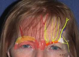 Image result for Forehead Regional Block