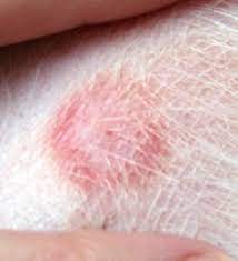 Does A Red Ring On My Dog Mean Tick Bite And Lyme Disease Pest Guides