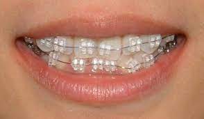 Pin On Braces