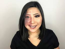 How could any guy be interested in me? I'd stare in the mirror, disgusted  and wondering, 'Why me?' Makeup became my security blanket.': Woman with  Port Wine Stain, Blue Nevus urges 'self-love