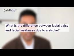 This nerve is located in the skull and travels beneath the ears to bell's palsy vs stroke symptoms. Bell S Palsy Facial Palsy Uk