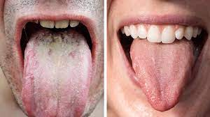 Researchers Explain What Tongue Color Says About Your Health Tongue Health Coconut Health Benefits Tongue Color Health