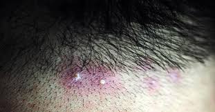 Por Que Salen Granos En La Cabeza