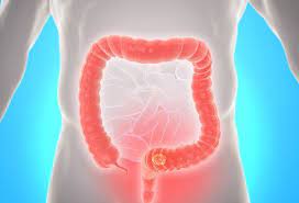 How do you know if you have it? What Does Colon Cancer Poop Look Like