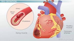 Silent heart attack some people have a heart attack with mild, brief symptoms or even no noticeable symptoms at all, which is why you can help prevent a heart attack by managing certain risk factors and making healthy lifestyle choices. Detecting A Heart Attack With An Ekg Video Lesson Transcript Study Com