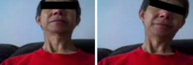 A chronic case of adult-onset Sandifer syndrome