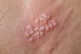 If this thought can't be shaken though, get a swab test of any lesions. Genital Herpes Patient Information Leaflet Qoctor Your Quick Online Doctor