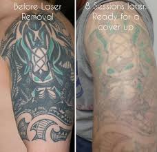 Laser tattoo removal is different for each client because every person and their tattoo is unique. Tribal Tattoo Laser Removal Before And After Novocom Top