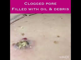 Pin On Pimple Popping Gold