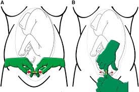 Blunt Expansion Of The Low Transverse Uterine Incision At Cesarean Delivery A Randomized Comparison Of 2 Techniques American Journal Of Obstetrics Gynecology