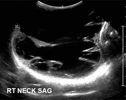 Its use is also limited in some parts of the body because the sound waves can't go through air (such as in the lungs) or through bone. Us Of Pediatric Superficial Masses Of The Head And Neck Radiographics