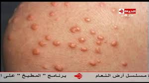 برنامج العيادة د سالي صفوت بالصور الأمراض الجلدية لمرض السكر The Clinic Youtube