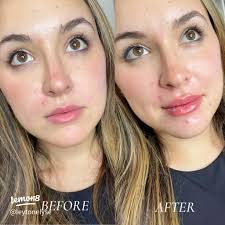 Experience Filler with Me at Radiant Wellness 💉