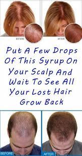 Put A Few Drops Of This Syrup On Your Scalp And Wait To See All Your Lost Hair Grow Back Info Health Tips Grow Hair Lost Hair Hair Loss Cure