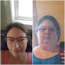 My 1 year from surgery is today. I wanted to share my side by side from  when I started photograph documentation. HW 409 SW 359 CW 237