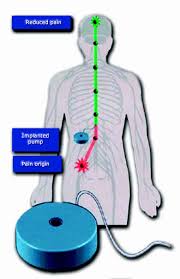 Image result for Intrathecal Pump