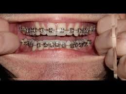 Braces Photo Taken Every Day Before And After Transformation Orthodontics Timelapse Youtube Dental Braces Teeth Braces Orthodontics