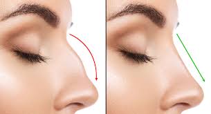 A good idea would be to first acknowledge which type of nose you have and how you can contour it. How To Treat A Dorsal Hump The Face Experts