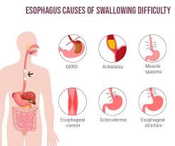 Image result for Swallowing