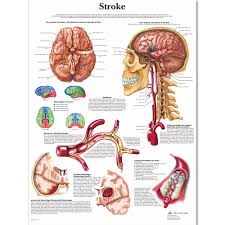 us 13 2 45 off anatomy of brain in stroke anatomical chart neurological posters pathology canvas wall pictures for medical education home decor in