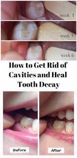 How to reverse tooth decay and cavities. How To Get Rid Of Cavities And Heal Tooth Decay Heal Cavities Teeth Health Tooth Decay