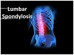 Image result for spondylolysis lumbar region