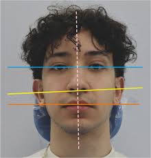 The use and modified use of the arbitrary facebow