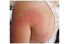 The cure | the top (1984). Skin Crawling Experience Caterpillar Gives Woman Hives Live Science