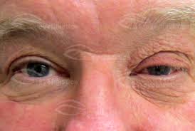 Eye itching that gets worse or lasts longer than 72 hours; Floppy Eyelid Syndrome Eye Lid Laxity Ectropion Entropio Floppy Eyelid Laxity Trichiasis