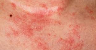 6 Tipos De Eczema Sintomas Y Causas