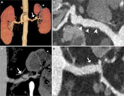 Image result for Renal Infarction