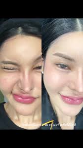 โบท็อกซ์ตีนกา 2 วัน ตาไม่แข็งขยับได้ปกติ