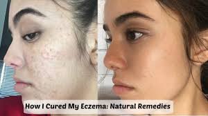 It helps in reducing the. How I Cured My Eczema Natural Remedies To Clear Skin Guemz Youtube