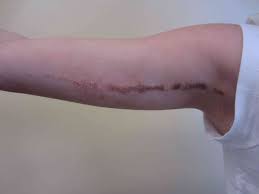Maybe you would like to learn more about one of these? Blaschko S Lines And Invisible Stripes On Human Skin