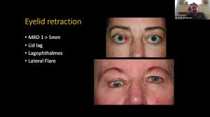 Lid lag means delay in moving the eyelid as the eye moves downwards. Lecture Thyroid Eye Disease Diagnosis And Management Youtube