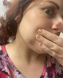 So this massive bruise was definitely not