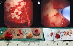 Malignant mesothelioma is a rare form of cancer typically caused by exposure to asbestos. Use Of Cryobiopsy During Pleuroscopy For Diagnosis Of Sarcomatoid Malignant Mesothelioma Thorax