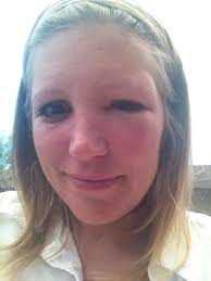 See full list on wikihow.com How To Make Swelling Go Down On Face