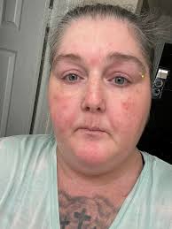 Lupus facial patches treatment