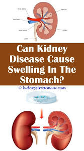 Kidney Health Facts Kidney Disease Polycystic Kidney Disease Kidney Infection Cure