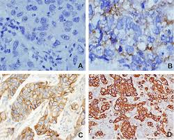 Ee lin lim medical lab technologist at pantai premier pathology kuala lumpur. Epidermal Growth Factor Receptor Egfr Gene Alteration And Protein Ov Ott